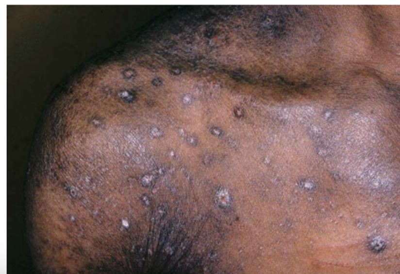 <p>Which parasites are transmitted by <strong>direct</strong> <strong>contact</strong> and via <strong>fomites </strong>causing <strong>pediculosis coporis?</strong> </p><ul><li><p><strong>widespread body</strong> <strong>pruritus </strong>as an allergic reaction to body lice <strong>saliva </strong>injected during feeding</p></li><li><p>primarily resides in <strong>clothing</strong> rather than on skin or hair</p><ul><li><p>often involving the <strong>trunk</strong> <strong>areas</strong></p></li></ul></li></ul>