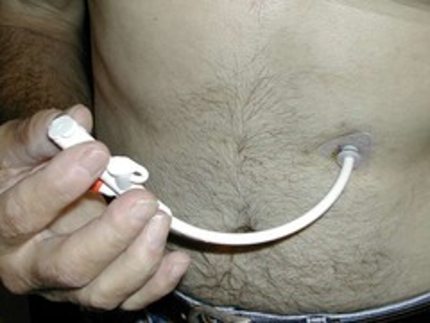 <p>a feeding tube placed through the abdominal wall into the stomach</p>