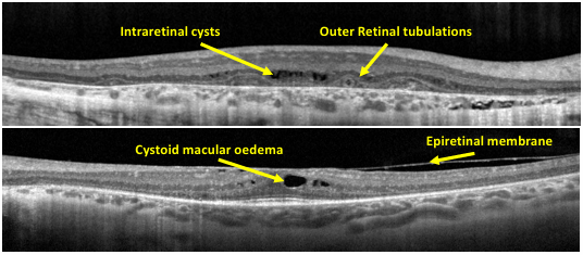 <p>Just look at this image and study the dI ff lesions you can see in OCT.</p>