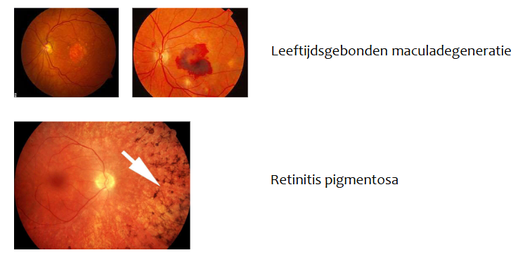 <p>→ degeneratie van staafjes en/of kegeltjes</p><ul><li><p>leeftijdsgebonden maculadegeneratie</p><ul><li><p>ziekte door veroudering</p></li><li><p>tast macula aan</p></li><li><p>scherpe centrale zicht wordt vernietigd → moeilijk om te lezen, auto te rijden &amp; gezichten te herkennen</p></li></ul></li><li><p>retinitis pigmentosa</p><ul><li><p>progressieve degeneratie van netvlies</p></li><li><p>tast nachtzicht &amp; perifere zicht aan</p></li><li><p>vaak voorkomend in families → veroorzaakt door defecten in verschillende genen</p></li></ul></li></ul><p></p>
