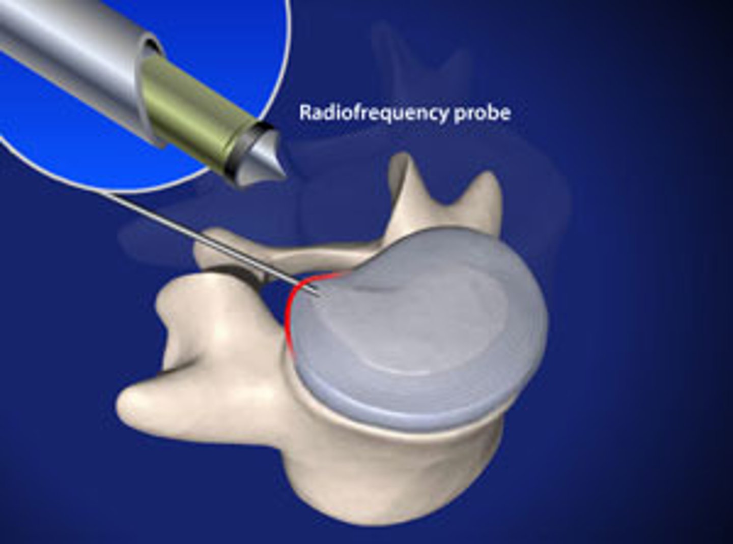 <p>radiofrequency discal nucleoplasty</p>