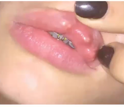 <p>patient presents with lumpy upper lip following DERMOTOLOGIST visit. what is the diagnosis </p>