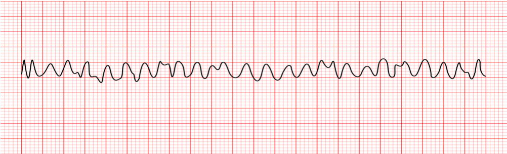 <p>What does this EKG represent?</p>