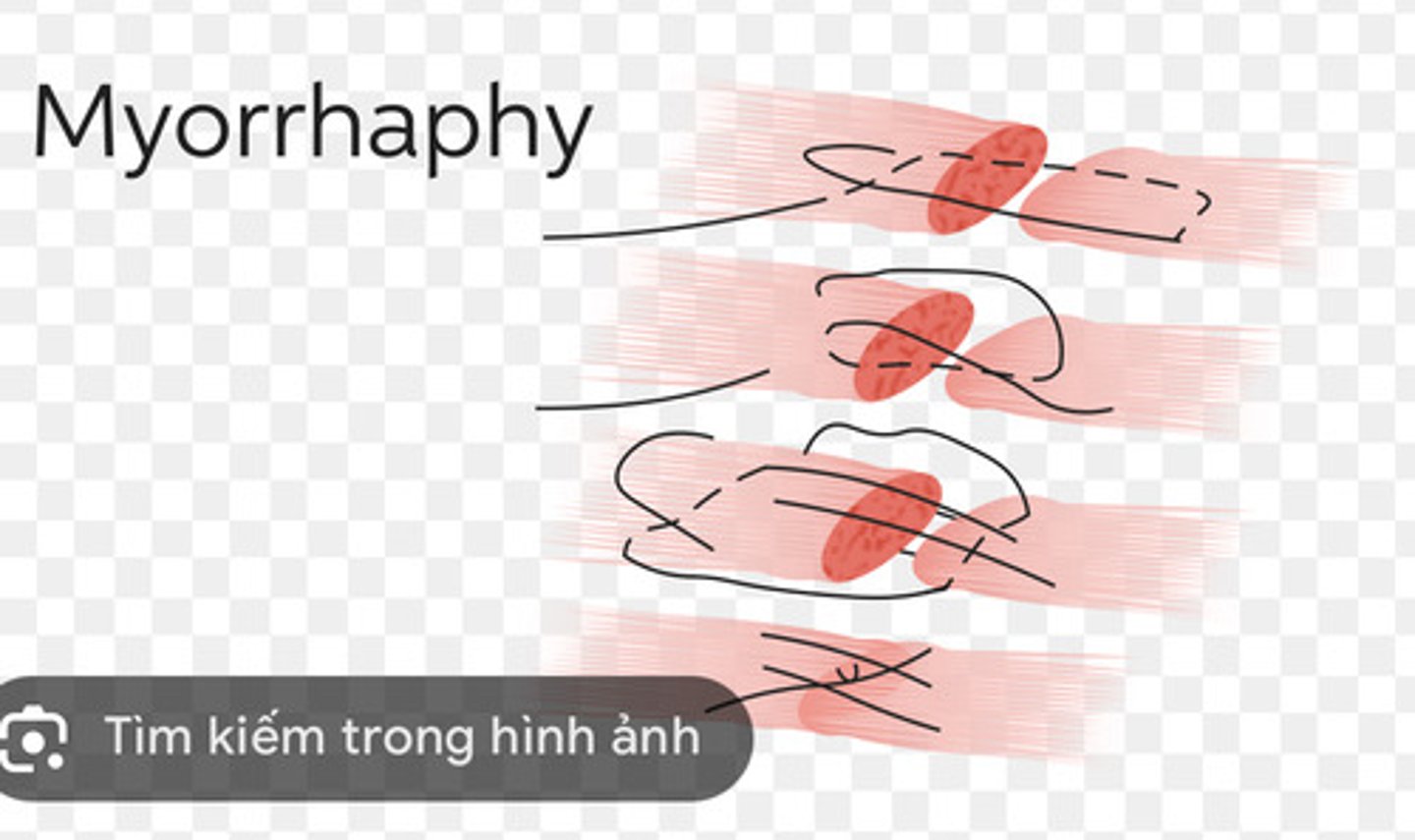 <p>is the surgical suturing (the method of sewing those tissues back together) of a muscle.</p>