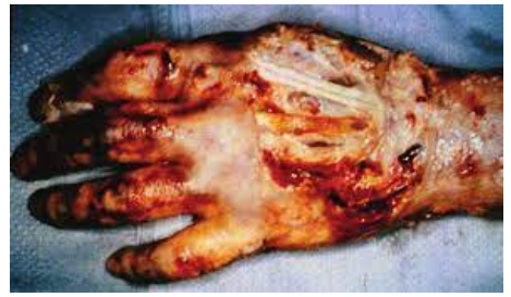 <p>Subdermal burn</p><p><em>Prolonged contact with a heat source or contact with electricity</em></p>