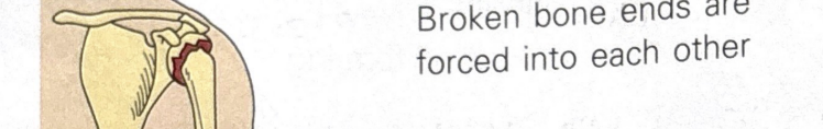 <p>fracture in which broken bone ends are forced into each other </p>