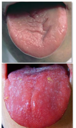 <p>yin deficient or yang deficient tongue?</p>