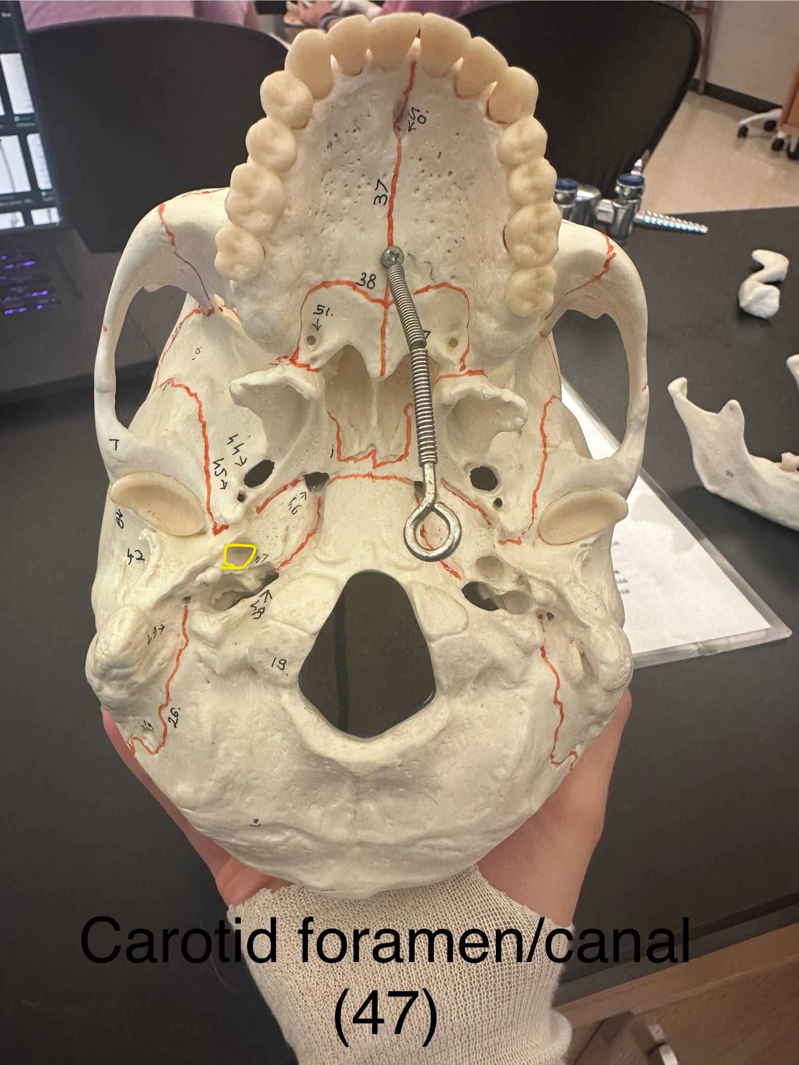 <p>Carotid Foramen (Canal)</p>