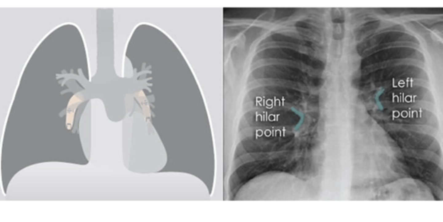 <p>⚬where the descending pulmonary artery intersects the superior pulmonary vein.</p><p>⚬When this is lost, consider the possibility of a lesion here (e.g. lung tumour or enlarged lymph nodes).</p>