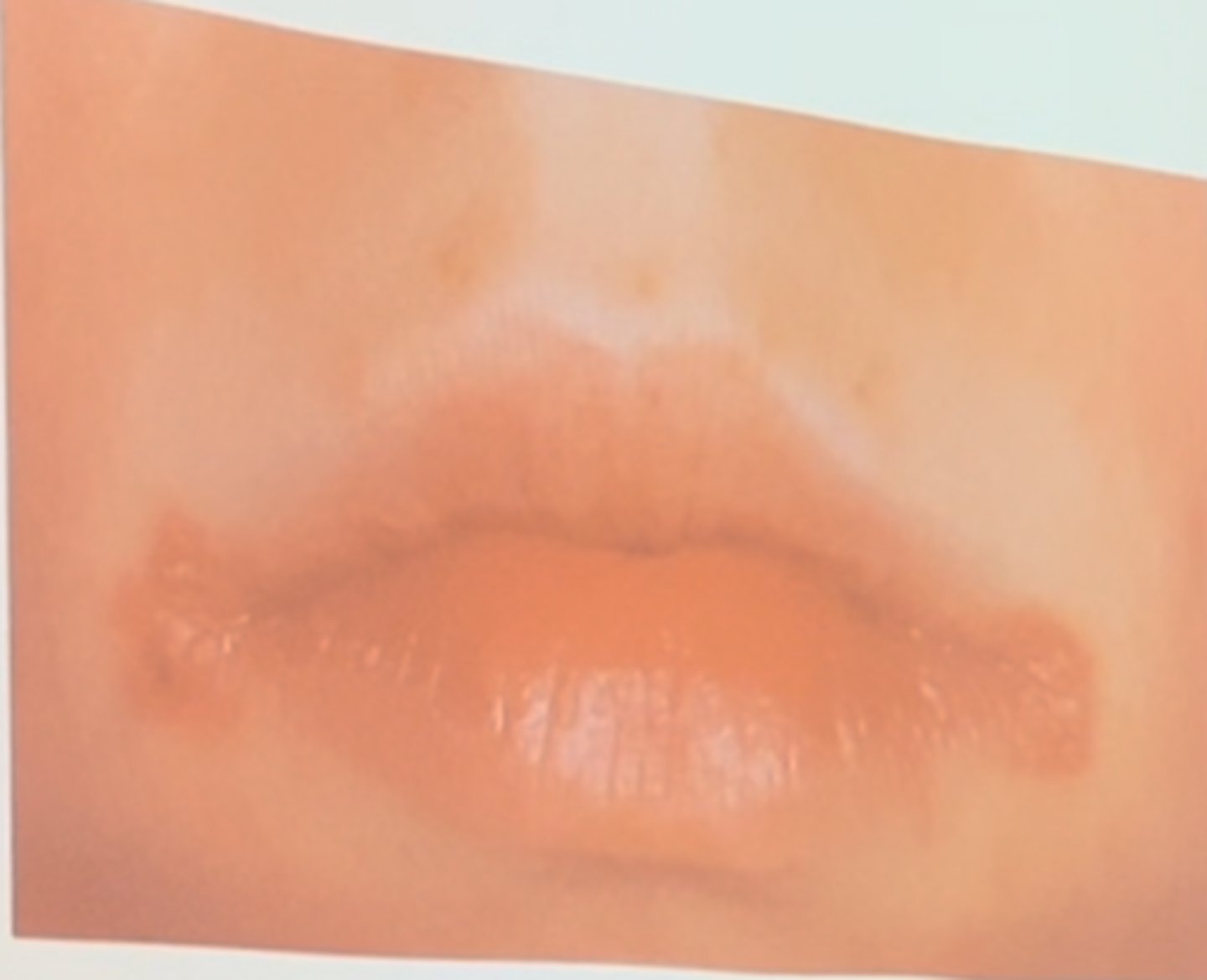 <p>Angular cheilitis</p><p>Angular cheilitis most commonly responds to antifungal therapy once nutritional deficiencies have been ruled out. Amelogenesis imperfecta is a genetic condition associated with abnormal development of the enamel. Paget disease is a chronic metabolic bone disease. A highly elevated serum alkaline phosphatase level contributes significantly to the diagnosis. A Stafne bone cyst is determined through surgical diagnosis in which entrapped salivary gland tissue is identified.</p>