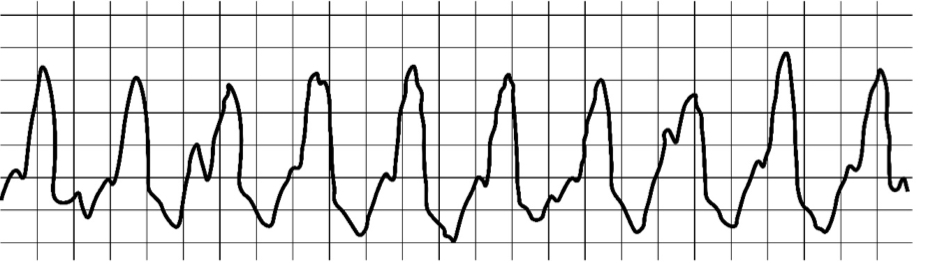 * wide QRS complexes
* P waves blends within the QRS

\
