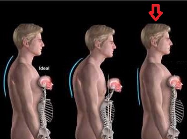 decrease in natural thoracic curvature, spine is too straight
