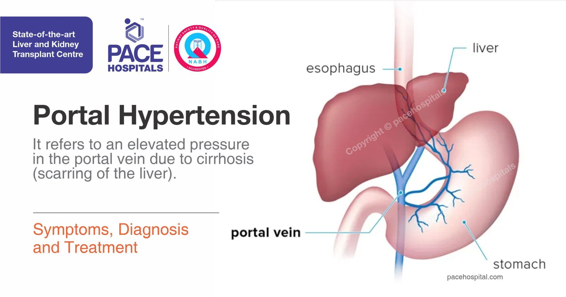 <p>Scarring blocks normal blood flow through the liver, <strong>increasing pressure in the portal vein (called portal hypertension).</strong></p>