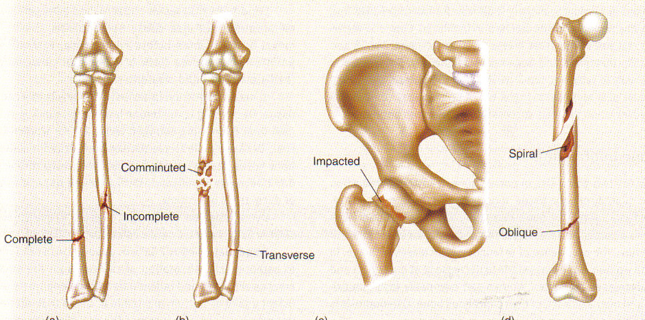 <p>Fracture Types: Complete Fracture</p>