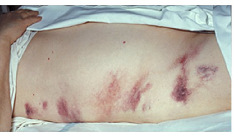 <p><strong>What is flank ecchymosis from retroperitoneal hemorrhage?</strong></p>