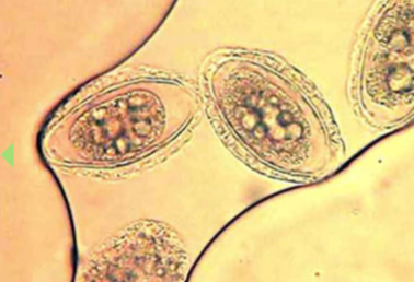 <p>kidney/abdominal pain, enlargement, hematuria, proteinuria, lethargy, weight loss, can destroy entire contents of kidney, just leaving a “shell”</p>