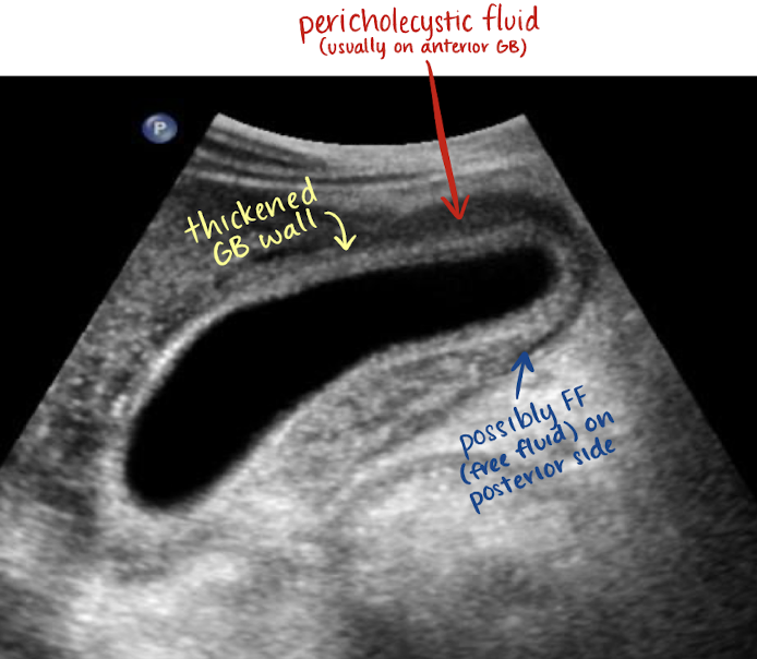 <p><mark data-color="yellow" style="background-color: yellow; color: inherit;">acute cholecystitis</mark></p><ul><li><p>thickened GB wall</p></li><li><p>pericholecystic fluid in anterior GB</p></li><li><p>?FF in posterior GB</p></li></ul><p></p>
