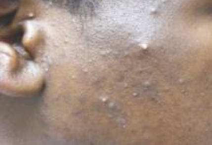 <p>inflammatory, comedones, papules and pustules</p>