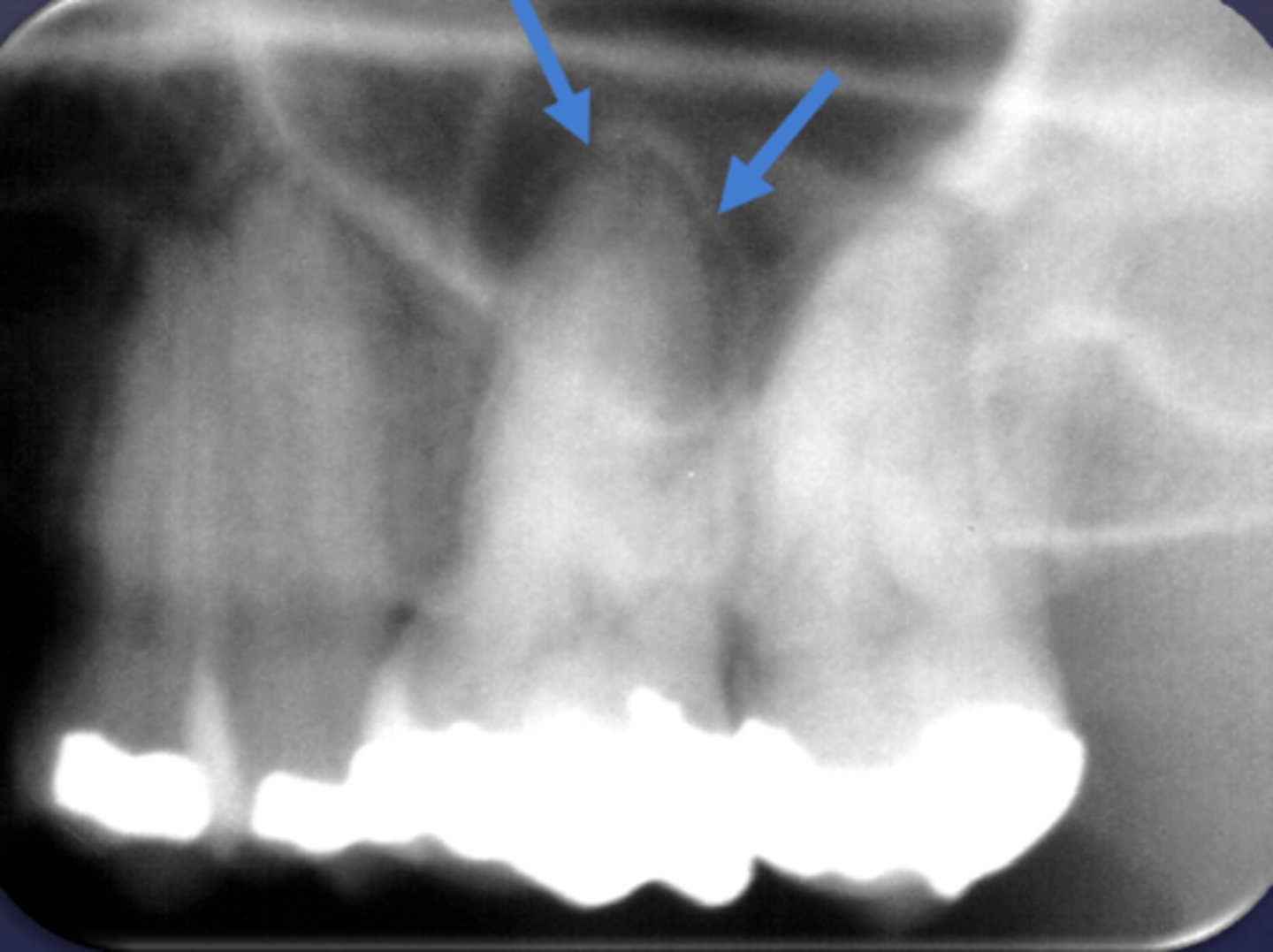 <p>What type of change is seen in this radiograph?</p>