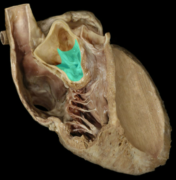 <p>Aortic (semilunar) valve</p>