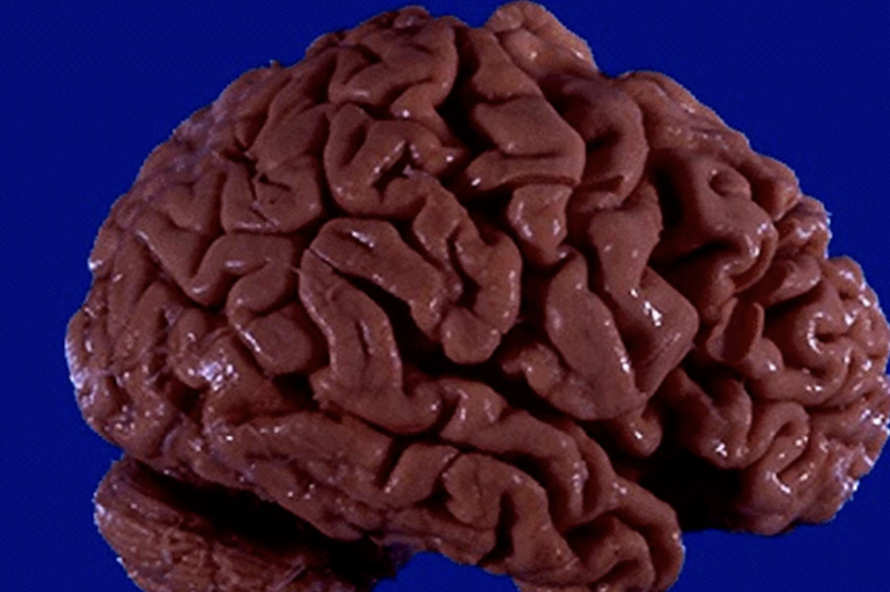 <p>Global brain shrinkage typical of Alzheimer dementia.</p>