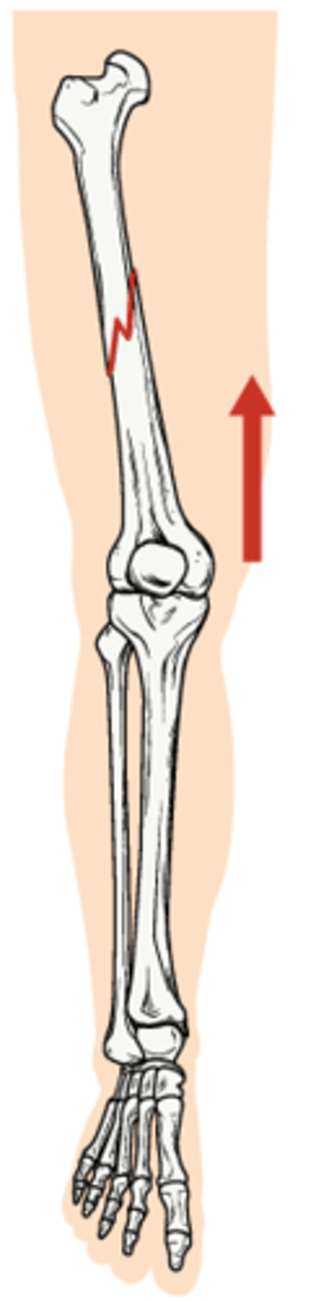 <p>Broken bone ends are forced into each other</p>