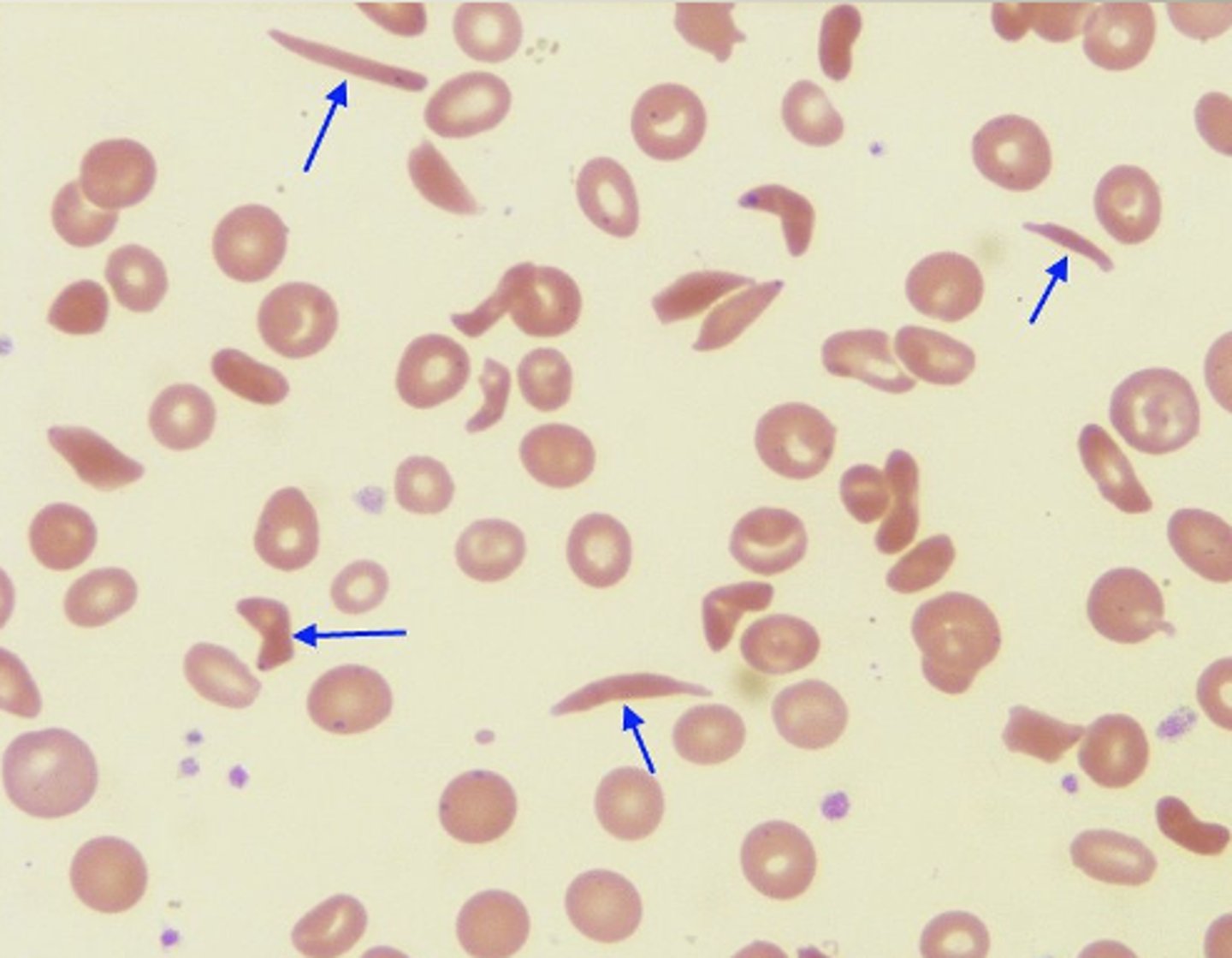 <p>- Less soluble<br>- Rigid<br>- Form tactoids= liquid crystals<br>- Hg S polymers= sickle</p>