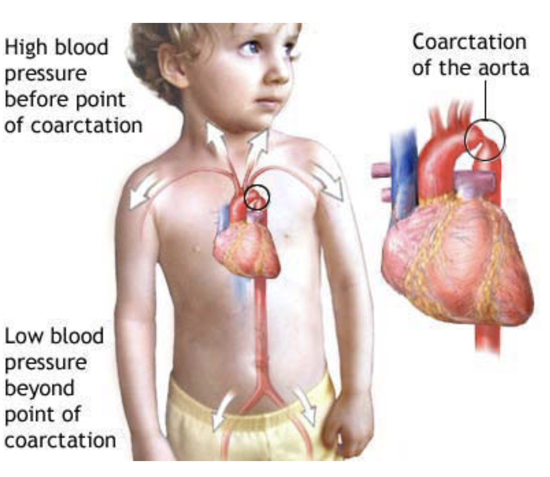 <ul><li><p>A congenital abnormality where the aortic lumen is constricted just distal to the origin of the left subclavian artery</p><ul><li><p>At this point the aorta becomes significantly narrowed &amp; the blood supply to the abdomen &amp; lower limbs is diminished</p></li></ul></li><li><p>Collateral vessels may develop around the chest wall &amp; abdomen to supply the lower body</p><ul><li><p>These intercostal veins which form a bypass to supply the descending thoracic aorta may lead to erosions of the inferior margins of the ribs — can be observed in radiographs as inferior rib notching</p></li></ul></li><li><p>This coarctation also affects the heart, which has to pump the blood at a higher pressure to maintain peripheral perfusion — may produce cardiac failure </p></li></ul>