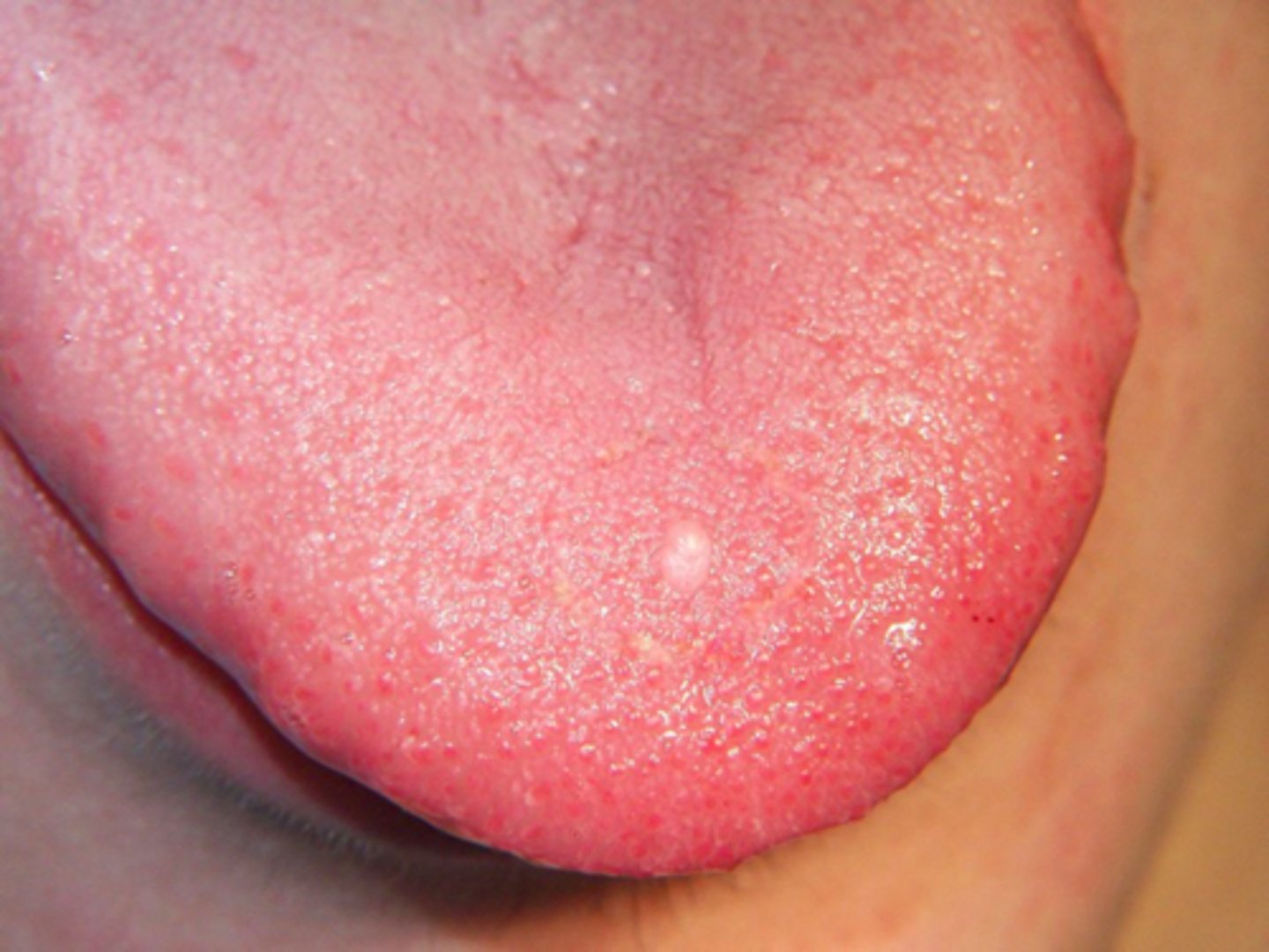 <p>patient presents with an asymptomatic nodule with papillary surface on the anterior dorsal tongue. Histopathologic features show vascular fibrous connective tissue , numerous large stellate fibroblasts that contain several nuclei and rete ridges narrow and elongated. What do you suspect?</p>