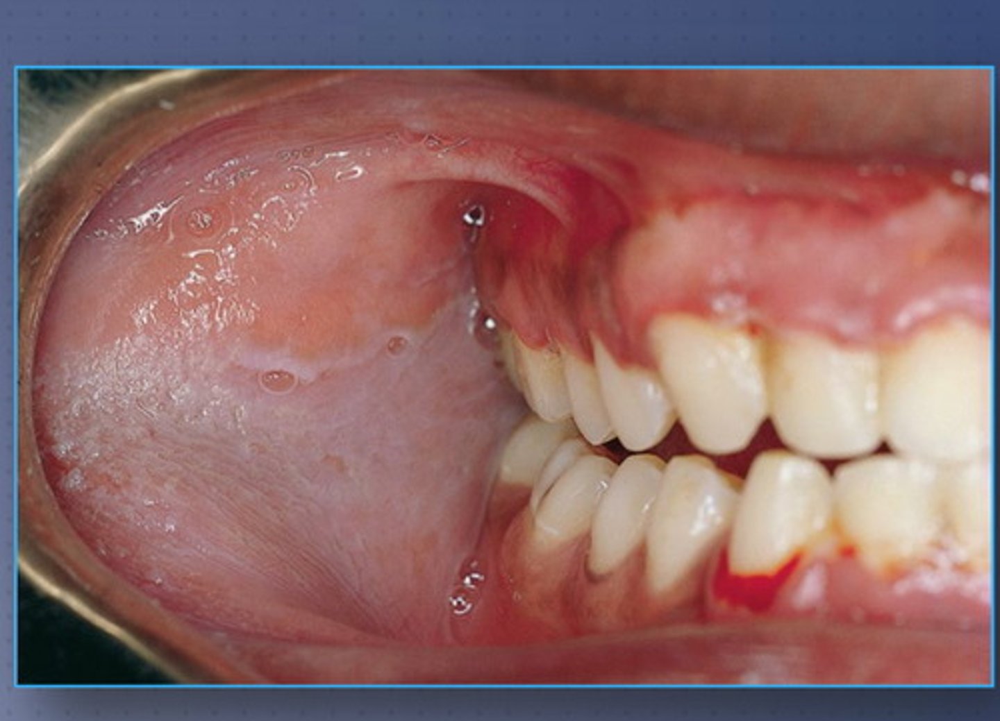 <p>a patient comes in with this on their buccal mucosa and it does not wipe off. what is the condition?</p><p>a. linchen planus</p><p>b. leukoplakia</p><p>c. leukoedema</p><p>d. linea alba</p>