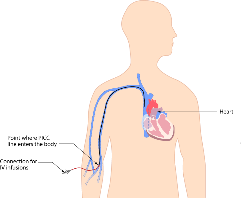 <p>What makes PICC lines advantageous for outpatient care?</p>