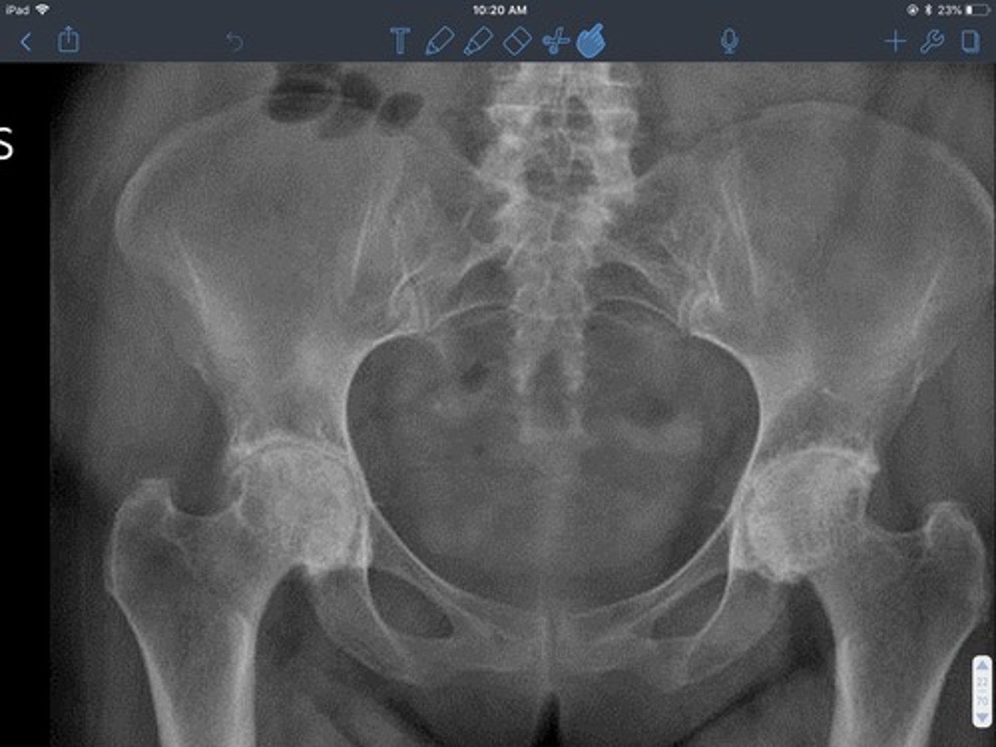 <p>- symmetrical joint space narrowing<br>- loss of bone density<br>- joint effusion</p>