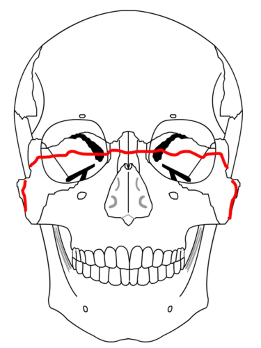 <p>Midface fracture, fracture through the lateral and medial orbital wall, across the nasal bridge and all the way down to the other side</p>