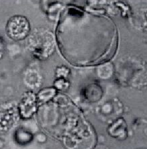<p>RTE cell containing large, nonlipid-filled vacuole</p><ul><li><p>Acute Tubular Necrosis</p></li></ul><p></p>