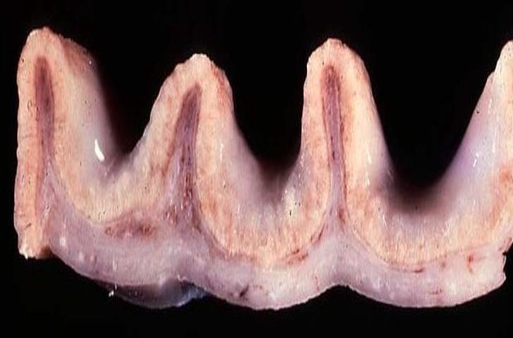 <p>more pics of hypercalcemia</p>