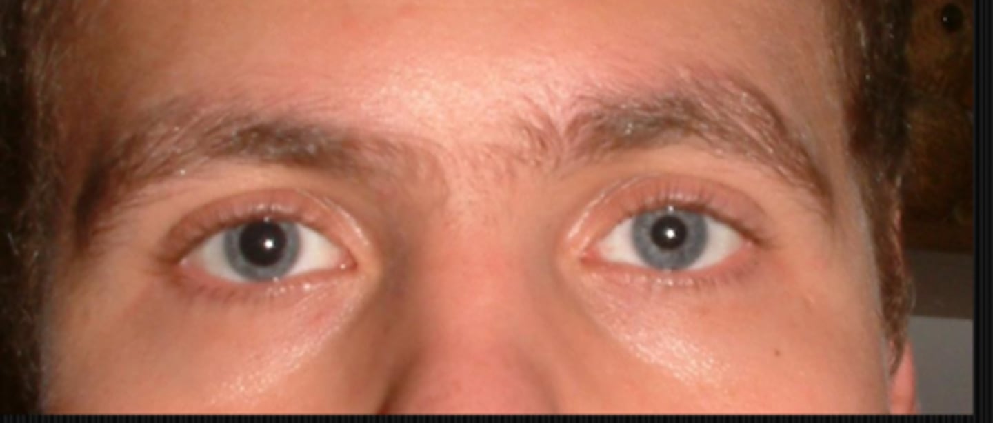 <p>pharmacological</p><p>Horner's pupil</p><p>tonic pupil</p><p>CN 3 palsy</p>