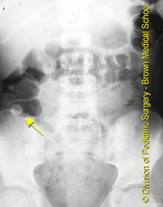 <p><strong>abd CT</strong> &gt; u/s</p><p>labs: CBC (mild leukocytosis), U/A (hematuria), CMP normal</p>