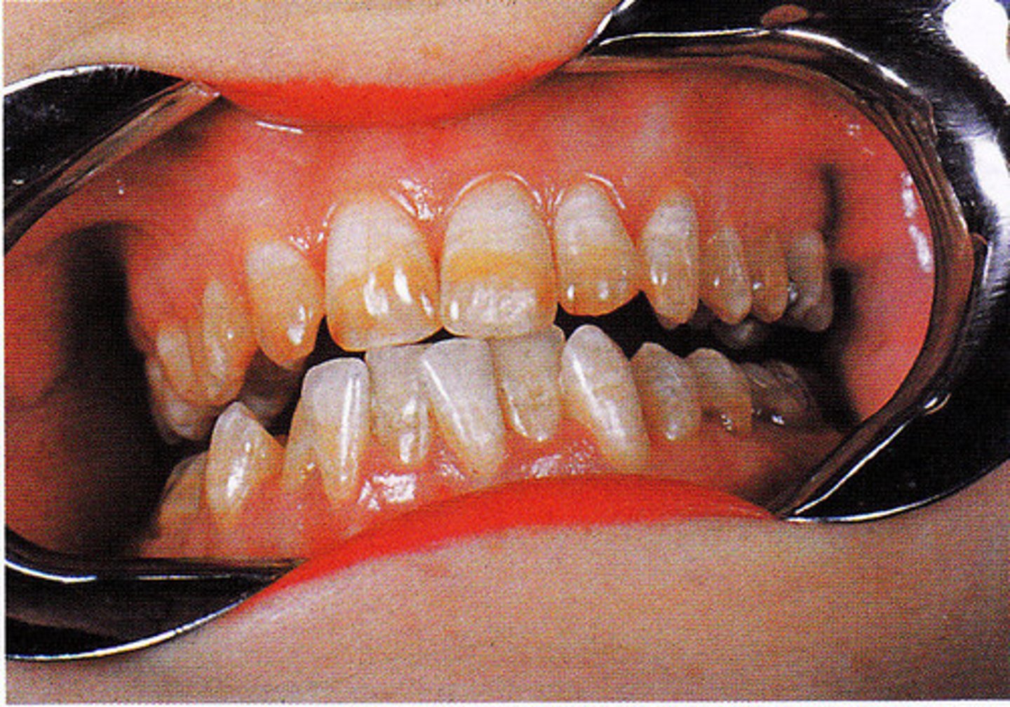 <p>"Turner's tooth"-hypocalcified permanent tooth</p><p>Enamel is inhibited possibly due to trauma affecting crown development</p>