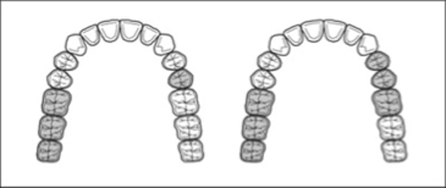 <p>Each additional edentulous area (beyond those that determine classification) is a _______ - not each additional missing tooth (Rule 7).</p>