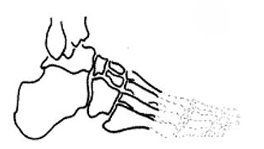 <ol><li><p><span style="color: red;">Balance and gait are affected:</span> ↓ WB area, ↓ lever arm</p></li><li><p><span style="color: red;">Muscle imbalances:</span> DF is often limited due to the loss of attachment points for the DF muscles</p></li><li><p><span style="color: red;">Skin breakdown and ulcer</span> due to sheer friction and pointed pressure</p></li></ol><p></p>