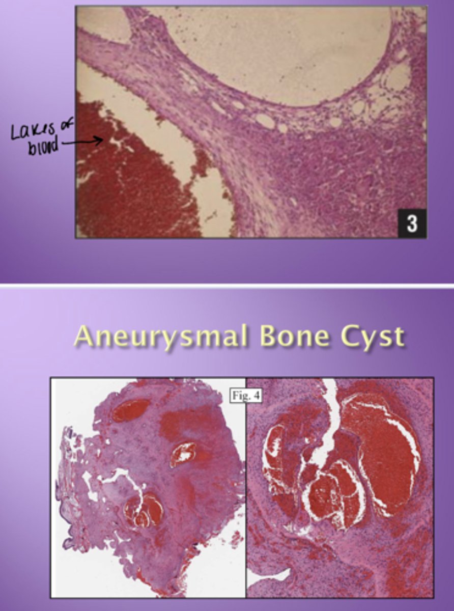 <p>Lakes of blood</p><p>- No endothelium around spaces</p>