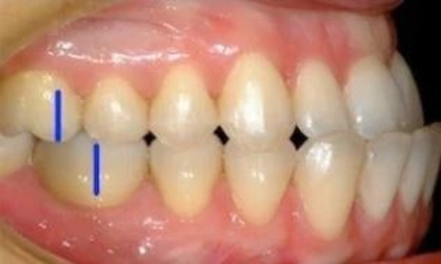 <p>When the mesiobuccal cusp of the maxillary first molar occludes posterior to the mesiobuccal groove of the mandibular first molar it is called Angle Class ___ occlusion. (bulldog look)</p>