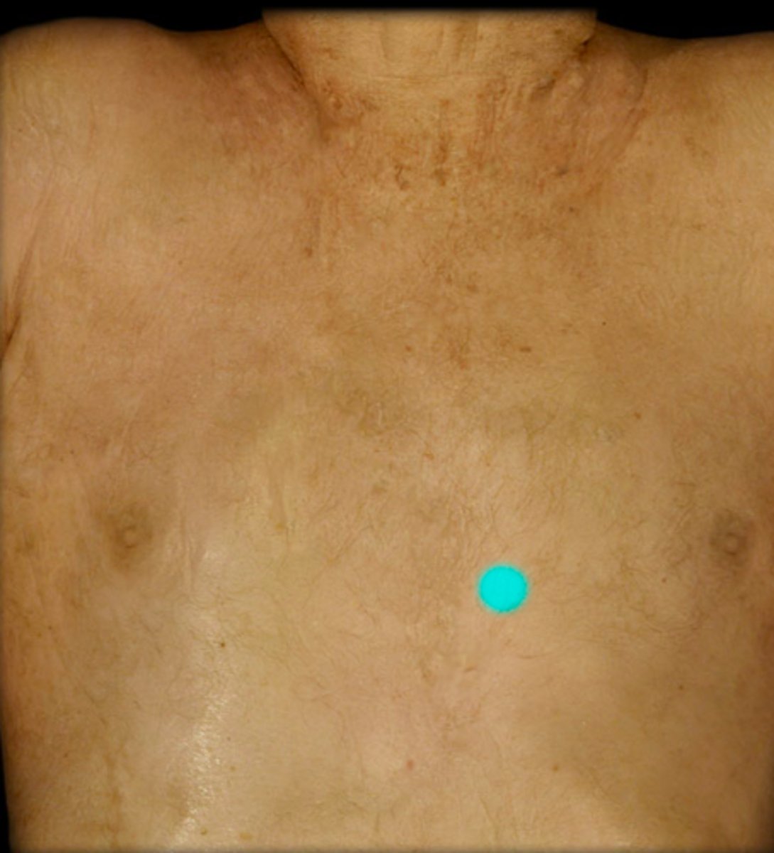 <p>4th intercostal space, L sternal border</p>