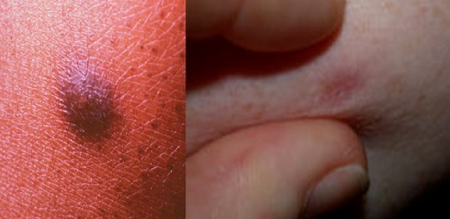 <p>Benign tumor of the skin </p><p>Firm, hyper pigmented papules w/ darkening of outer ring </p><p>Dimples when you put pressure on outer sides of the growth </p><p>Common on extremities</p>