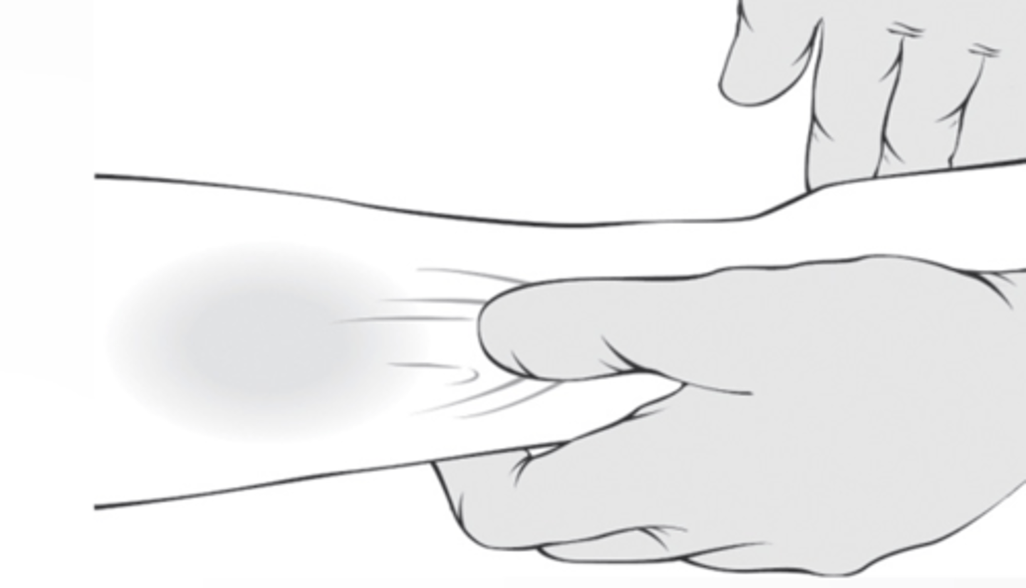 <p>Use the thumb of your non-dominant hand to gently pull the skin and subcutaneous tissue taut (about 1–2 inches) below the venipuncture site to straighten and anchor the vein in place </p>