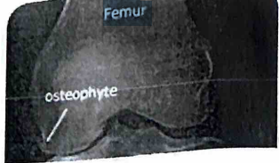 <p>Using your knowledge of knee mechanics and the tendency for osteoarthritis to affect a certain side of the tibiofemoral articulation, you deduce that this standing anterior-posterior radiograph is of the person’s ____________ knee.</p><p>a. left</p><p>b. right</p>