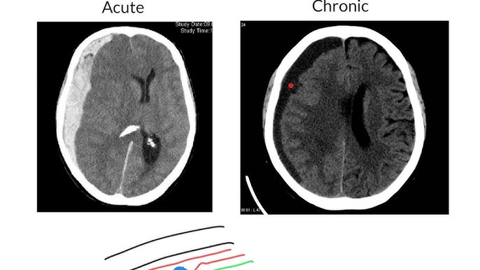 <p>Subdural haemorrhage pathology </p>
