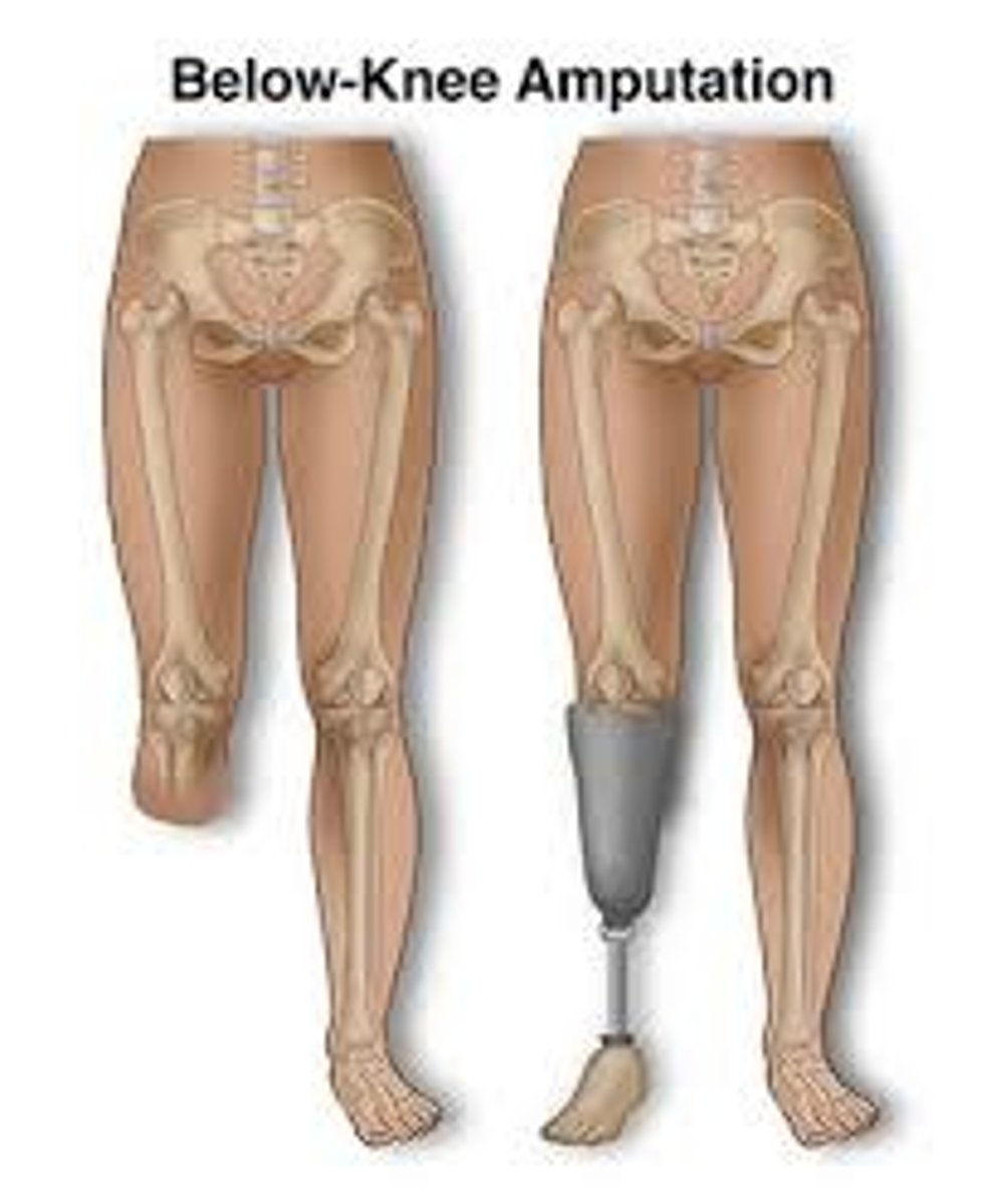 <p>BKA - below the knee amputation (transtibial)</p>