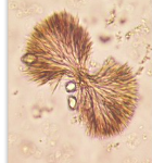<ul><li><p>acidic urine</p></li><li><p>soluble with acetone and alkaline</p></li><li><p>seen in patients taking sulfonamide antibiotics who are dehydrated → can cause tubular damage</p></li><li><p>shapes: flat needles, sheaves, small needles, spheroids, brown</p></li></ul><p></p>