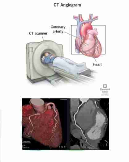 <ul><li><p>Coronary angioplasty with or without <span style="color: var(--color-neutral-black)">stenting is a nonsurgical procedure used to open clogged or narrow coronary arteries due to underlying atherosclerosis.</span></p></li><li><p>Done with CT machine and <span style="color: var(--color-neutral-black)">injection of IV contrast medium to obtain images of blood vessels and to diagnose coronary artery disease.</span></p></li><li><p>However, calcium scores &gt; 1000 prohibit CTA <span style="color: var(--color-neutral-black)">accurate interpretation.</span></p></li></ul>